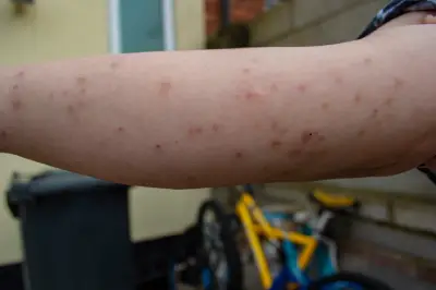 severe bed bug bites on arm